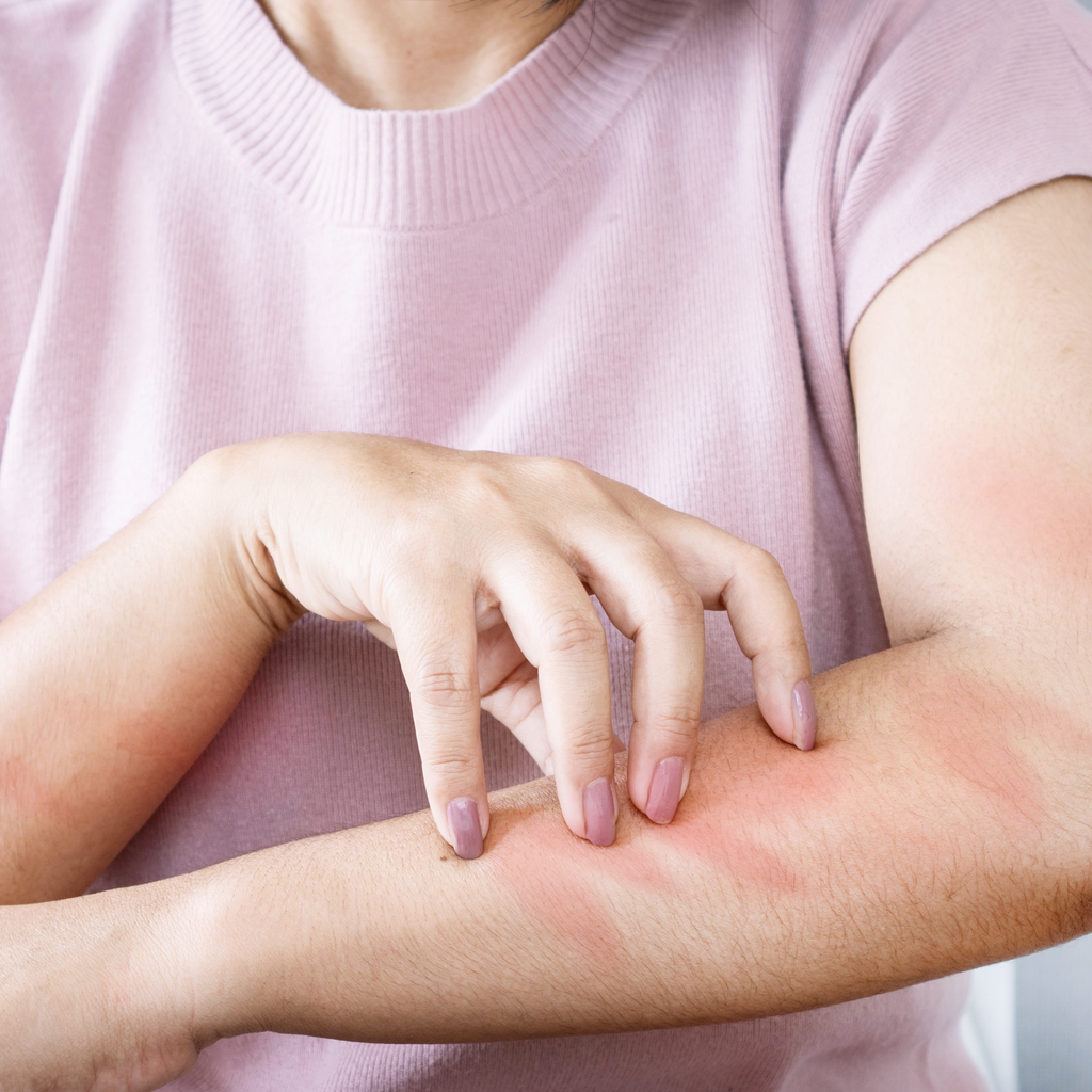 Why does eczema itch